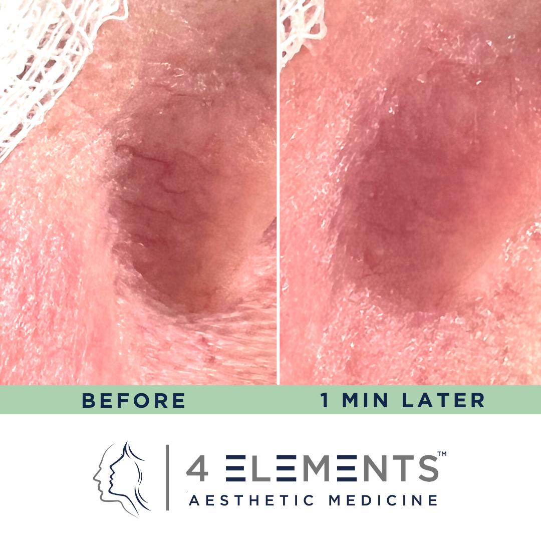 Vein treatment result